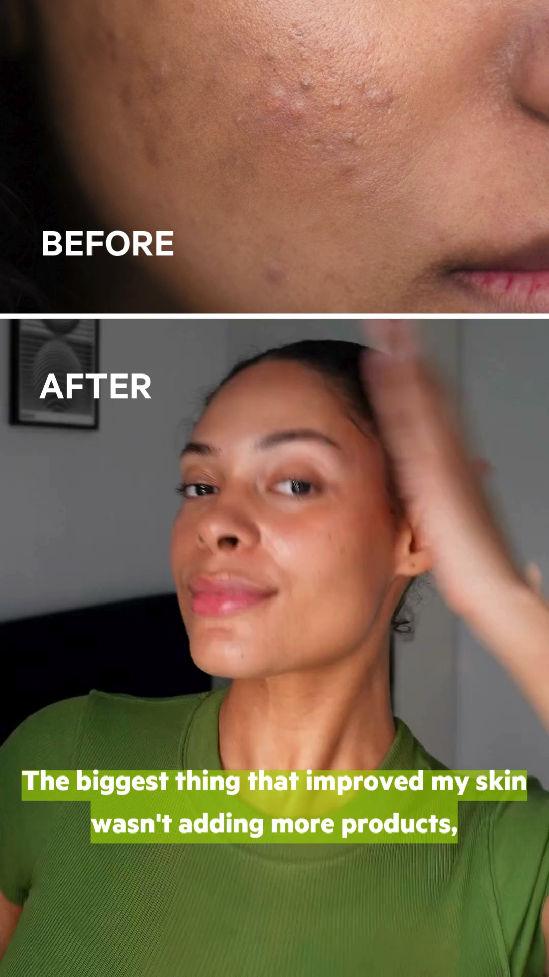 Your Acne-Prone Skin Routine, Simplified