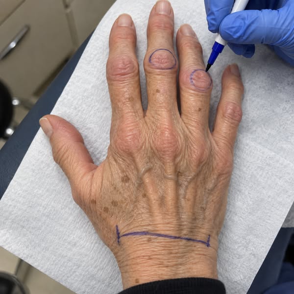 Carpal tunnel AND arthritis? Read this.