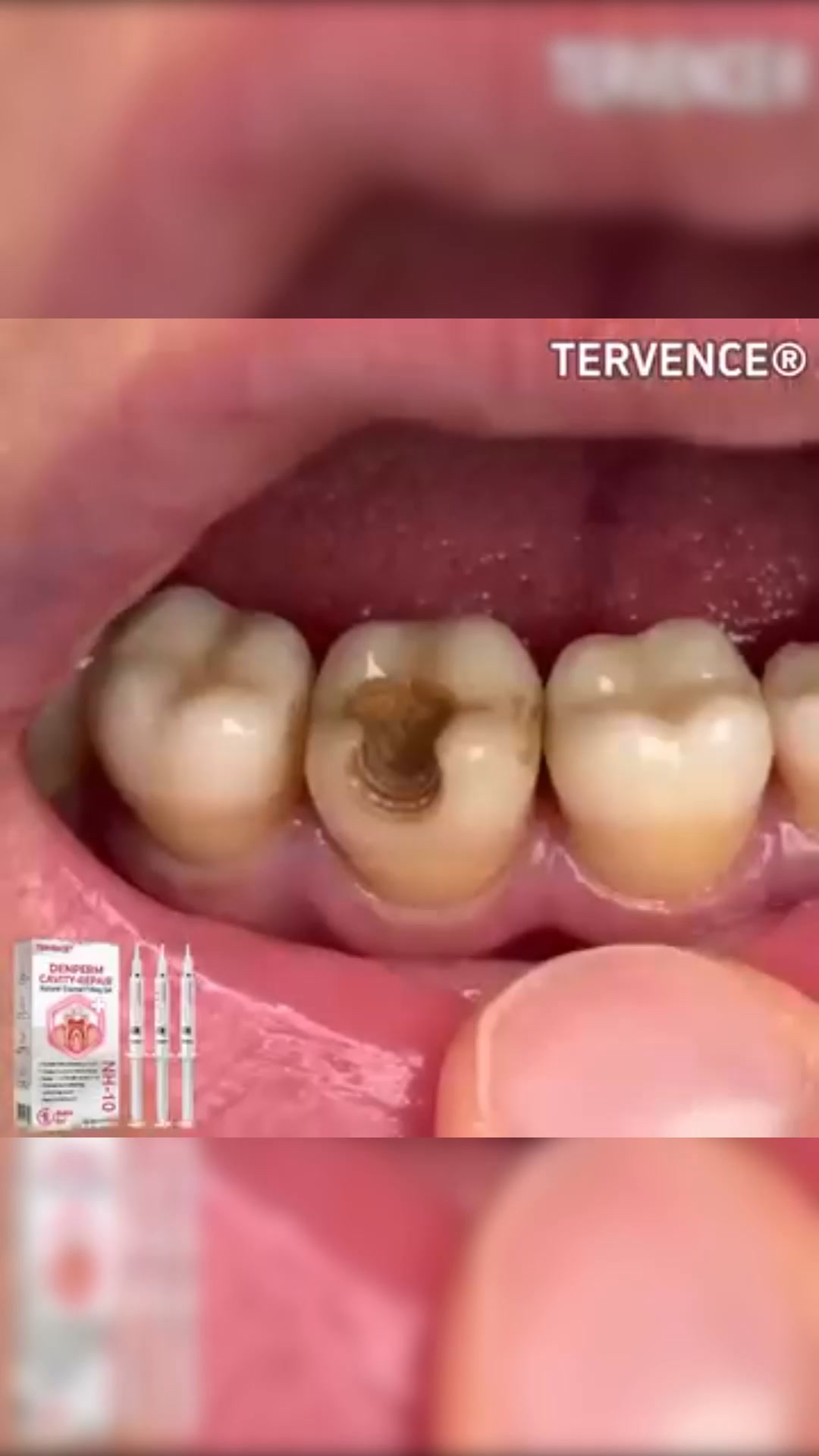 Restore Your Smile With Natural Enamel Repair Technology