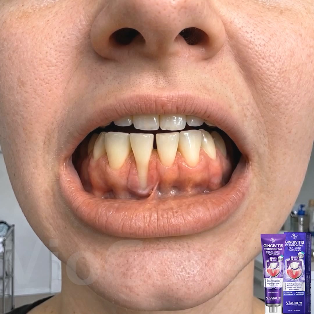 Gum Healing Endorsed by the British Dental Association (BDA) | Delivery within 2-4 working days | Full refund guarantee