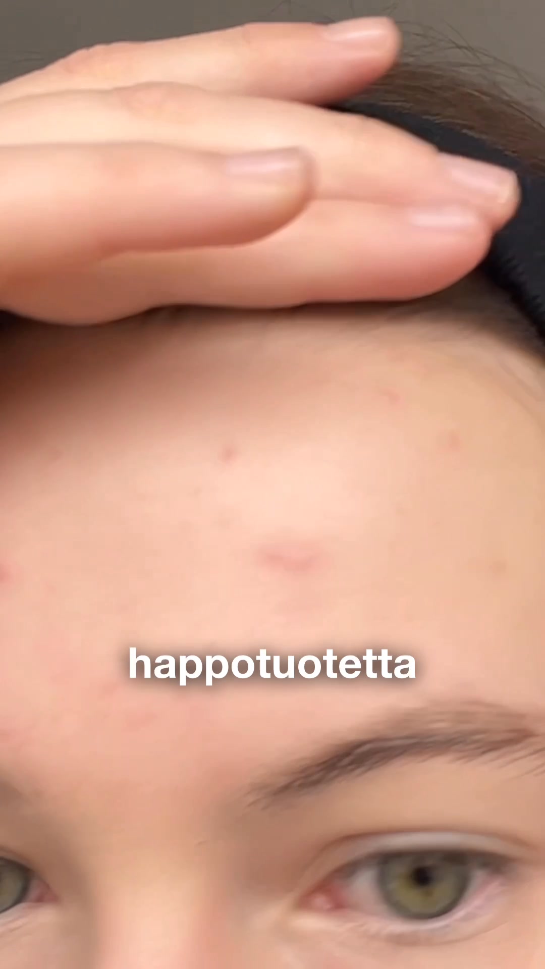 Epäpuhtauksiin, näppyihin, mustapäihin..
