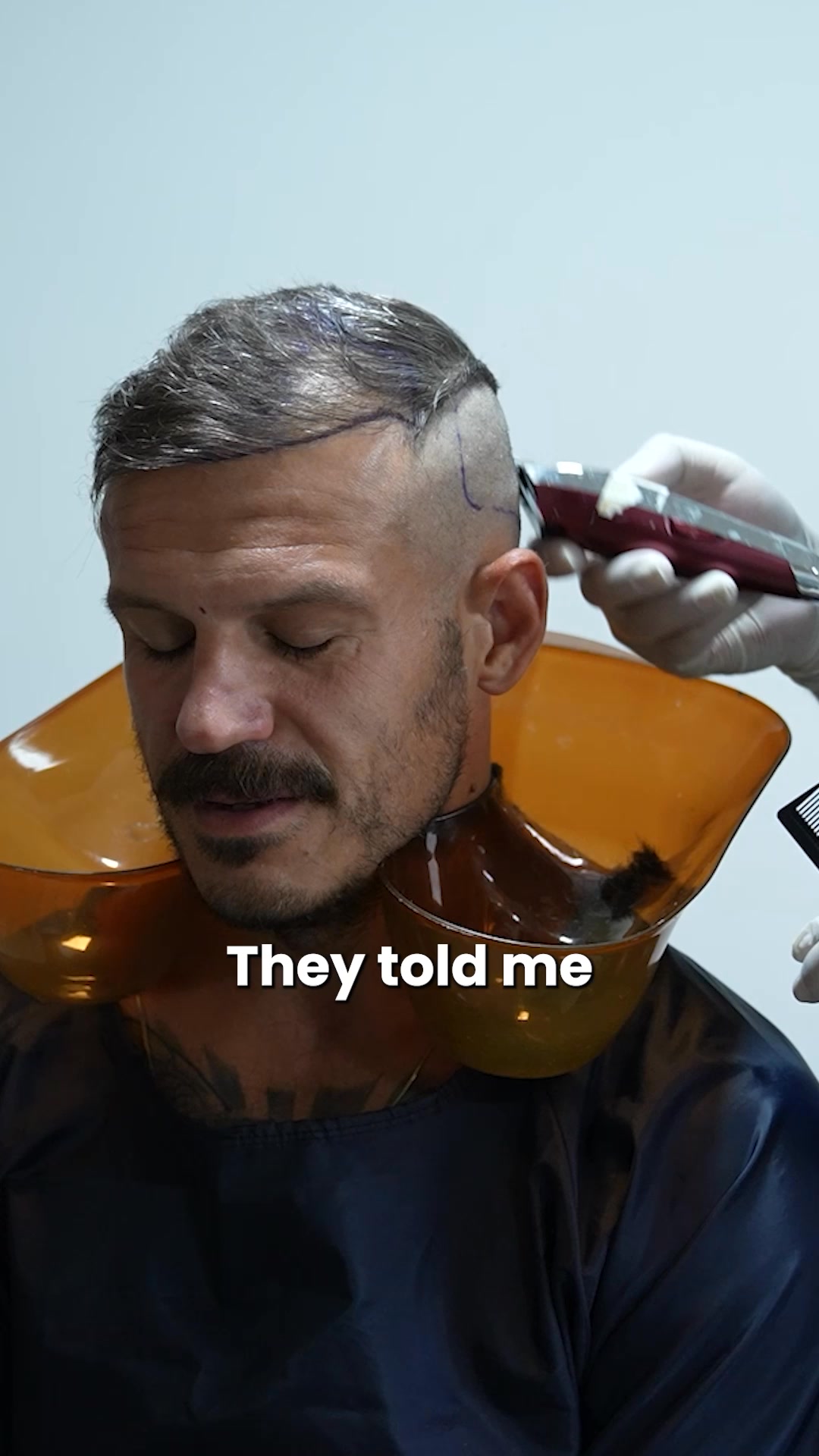 Hair Transplant in Turkey
