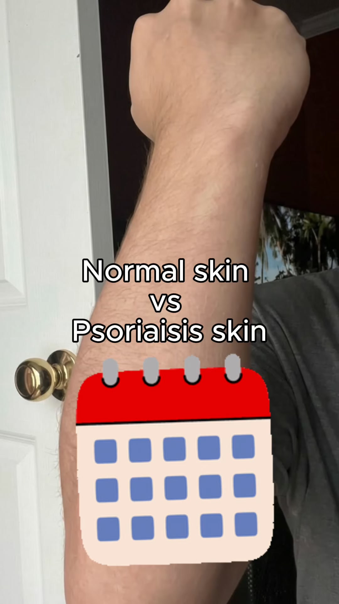 Psoriasis-Prone Skin, Meet Methylene Blue.