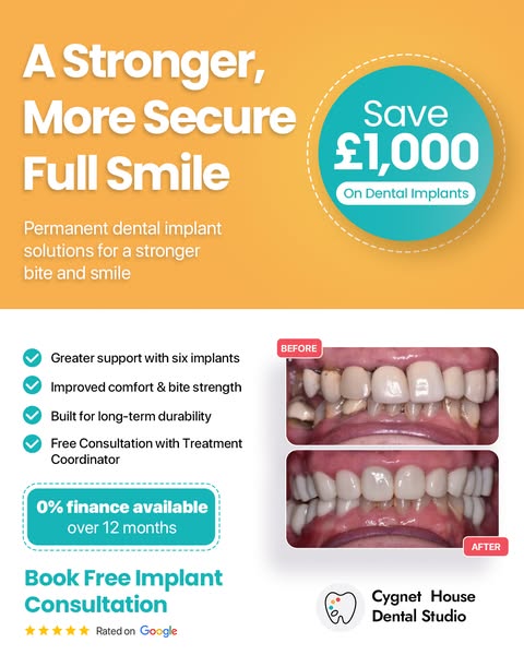 Save Up to £1,000 on Dental Implants
