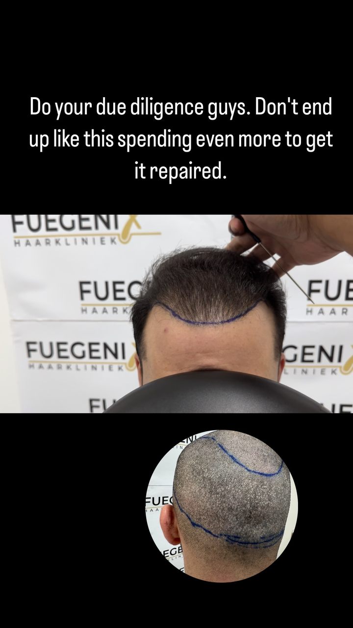 Anúncio de FueGenix Haarkliniek