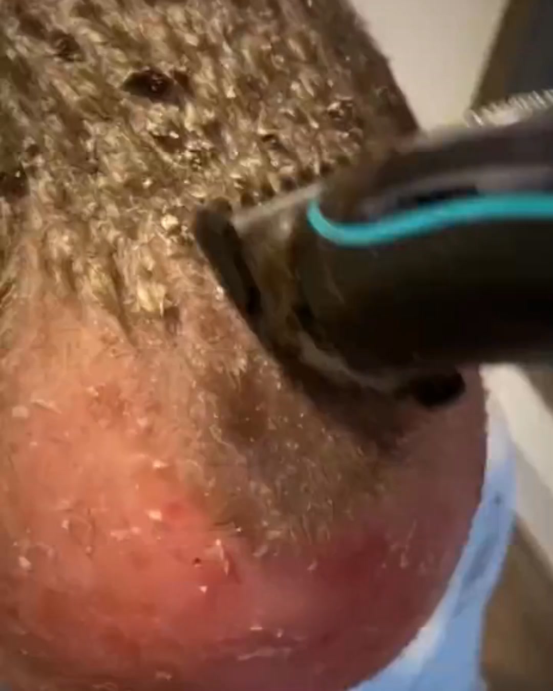 Hoe je jeuk en psoriasis op de hoofdhuid snel kunt verlichten
