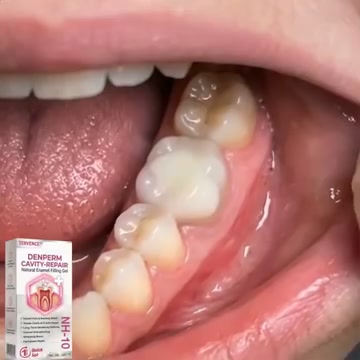 Cavity Repair | FDA-Recognized 10% Nano-Hydroxyapatite (NH-10) | Delivery Within 2–4 Business Days | Full Money-Back Guarantee