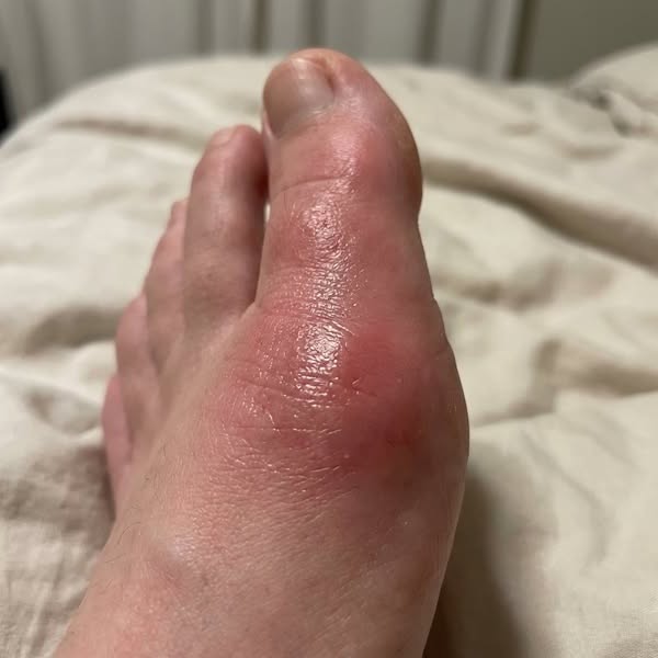 Six years of gabapentin for nothing