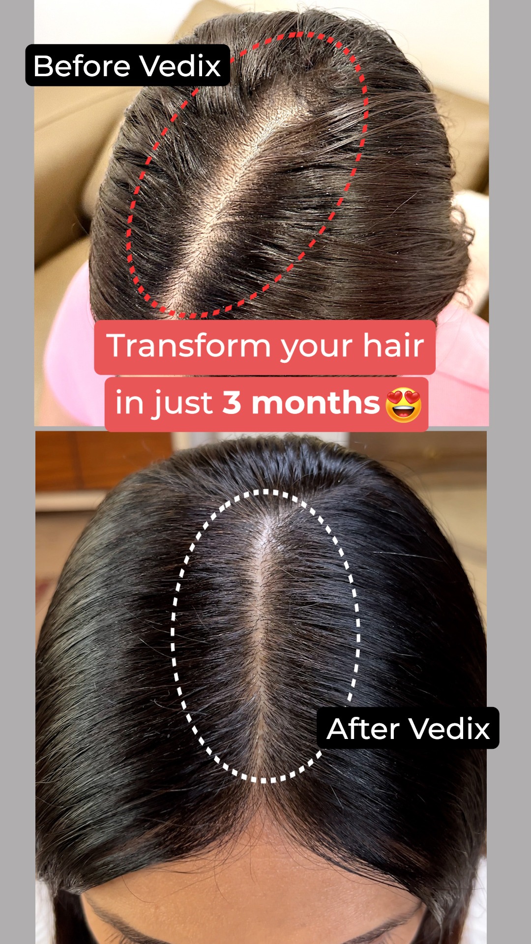 Get 100% Natural Ayurvedic Hair Care For Damage-Free Hair Only With Vedix - Shop Now