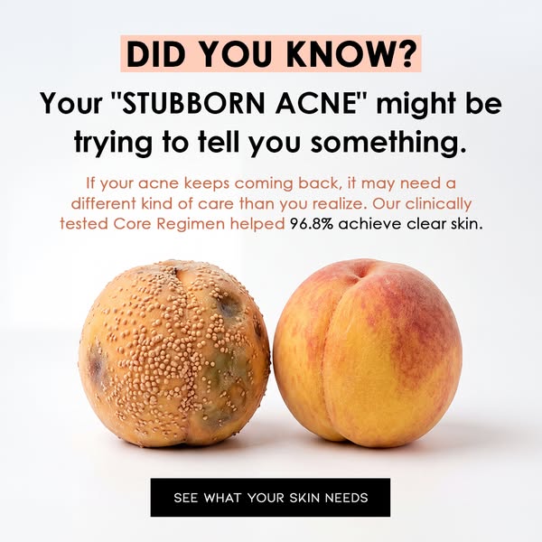 Maybe It Isn’t Just Stubborn Acne
