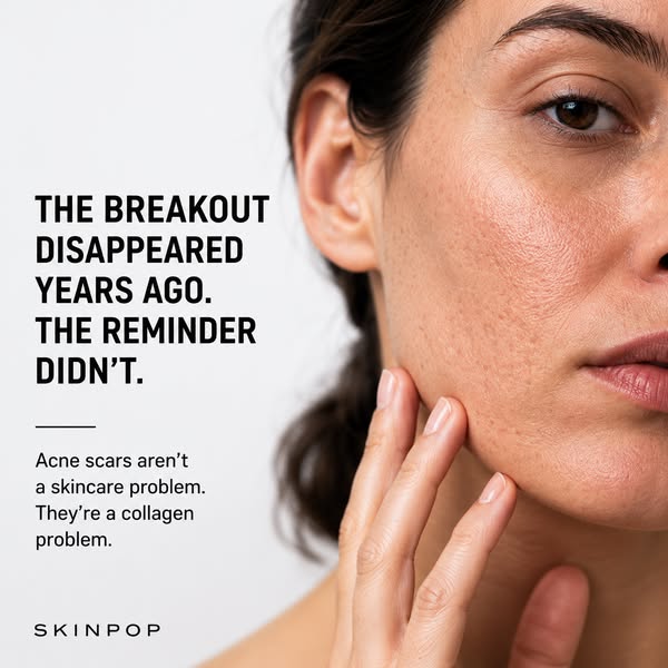 You've Cleared The Acne. Now Clear The Reminder
