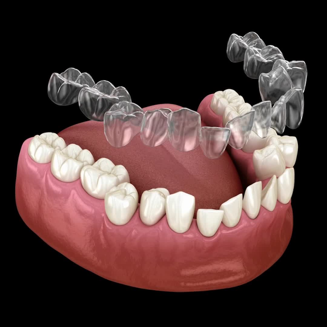 FREE Invisalign® and Smile Makeover Day Consultation