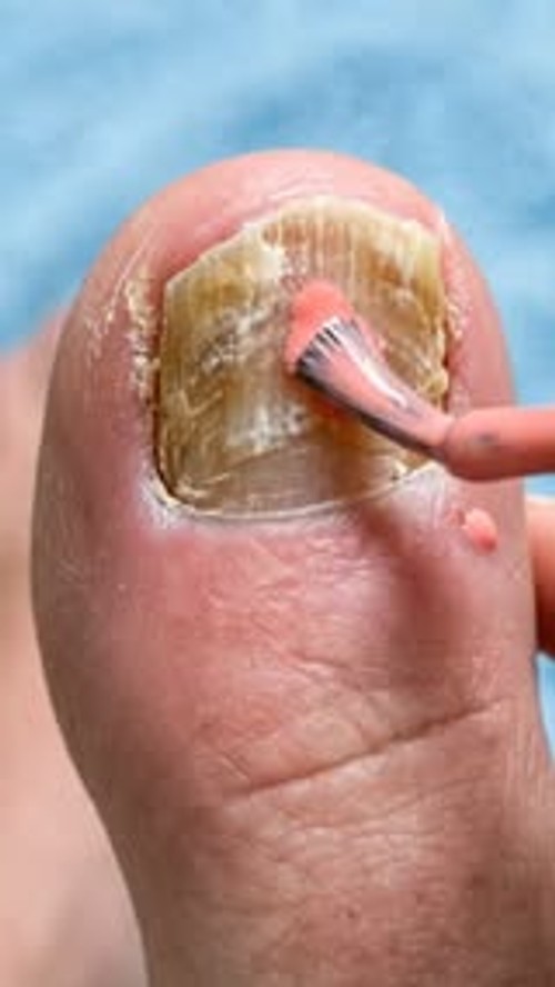 Free Yourself from Fungal Issues!