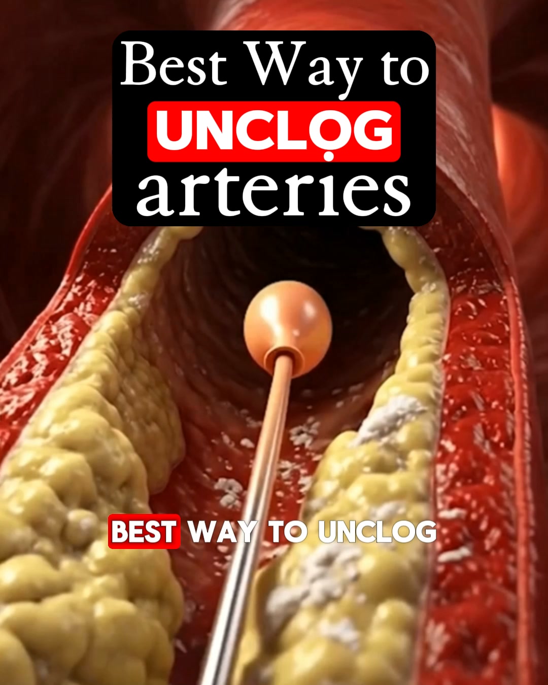 Plaque In Your Arteries? Stop Doing This.