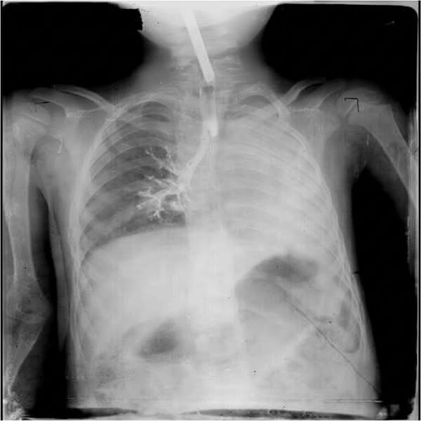 The cough that never left
