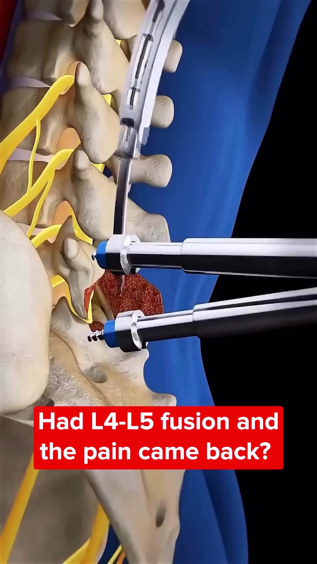 The One Muscle Most Post-Fusion Patients Never Hear About
