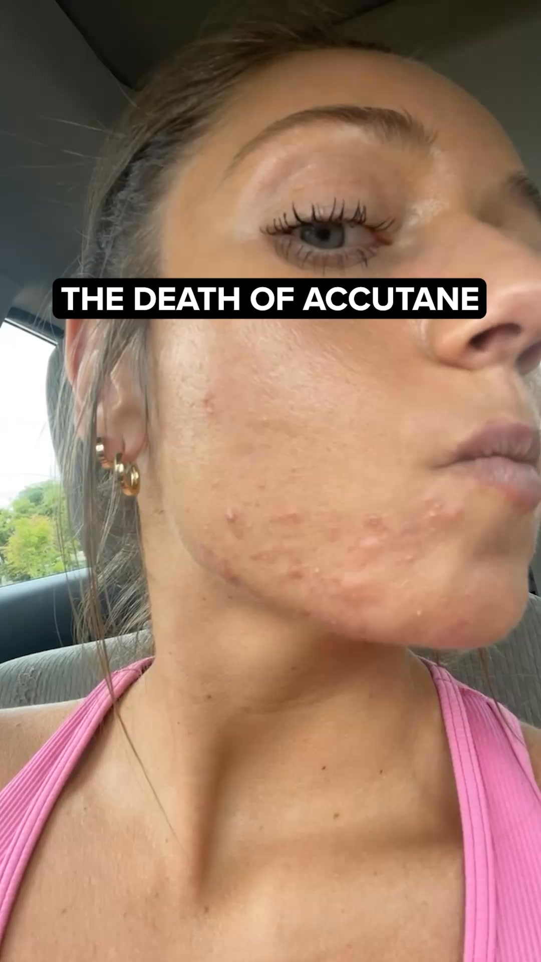 More steps. More products. Same breakouts