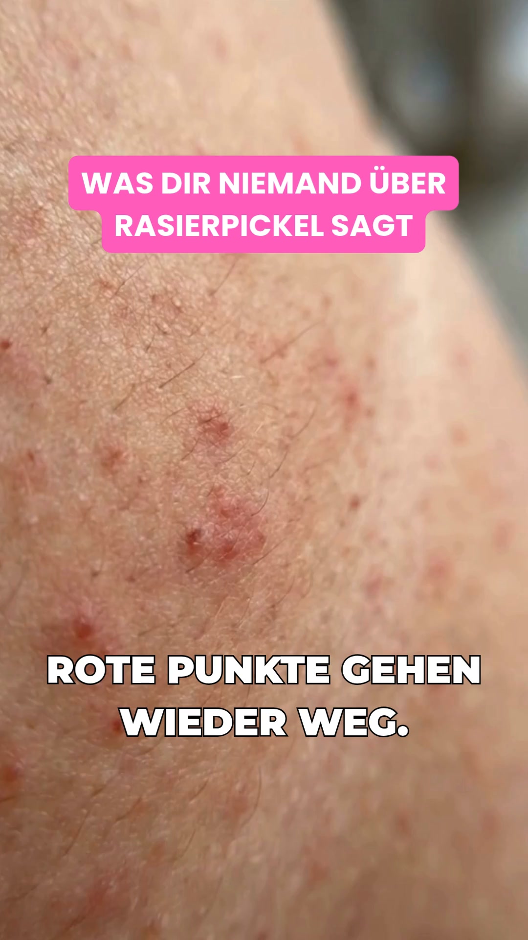 Glatte Haut ohne Rasierpickel