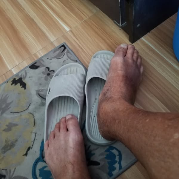 Always burning feet