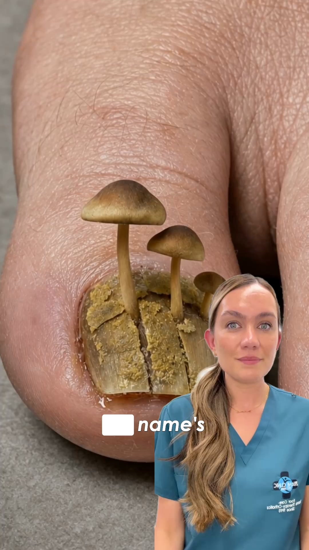 Fungal Nails? Find The Cause