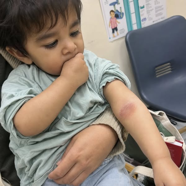 Child With Eczema | Read This