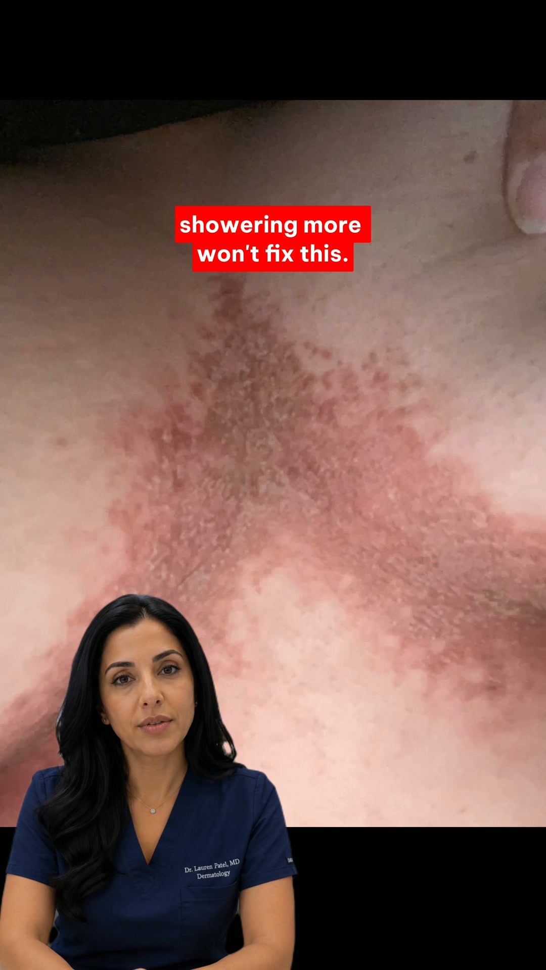How to Clear Skin Fold Rash in One Week