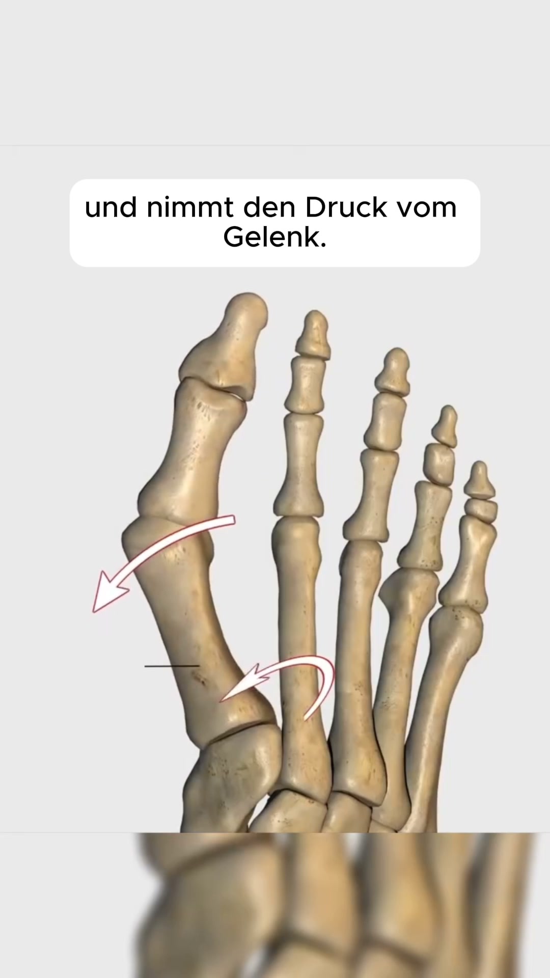 Wochenlang ausfallen für eine Hallux-OP? Geht bei vielen Frauen einfach nicht. Das hier ist der andere Weg.