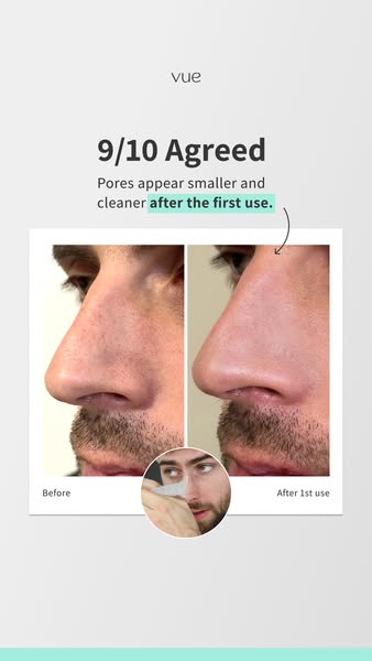 From Oily Nose to Clear Skin