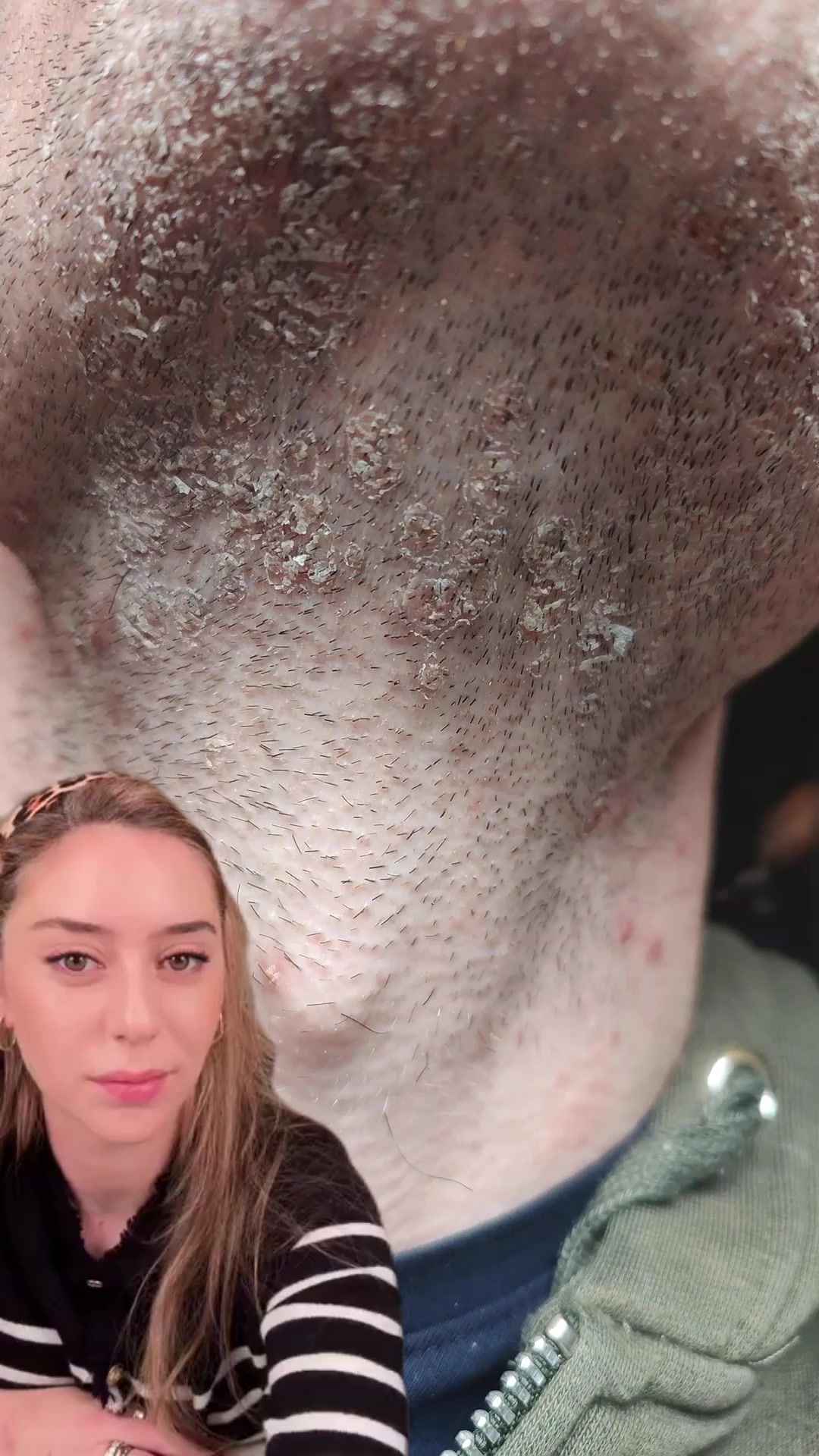 Still itching? It's not dry skin — it's fungus living on your face