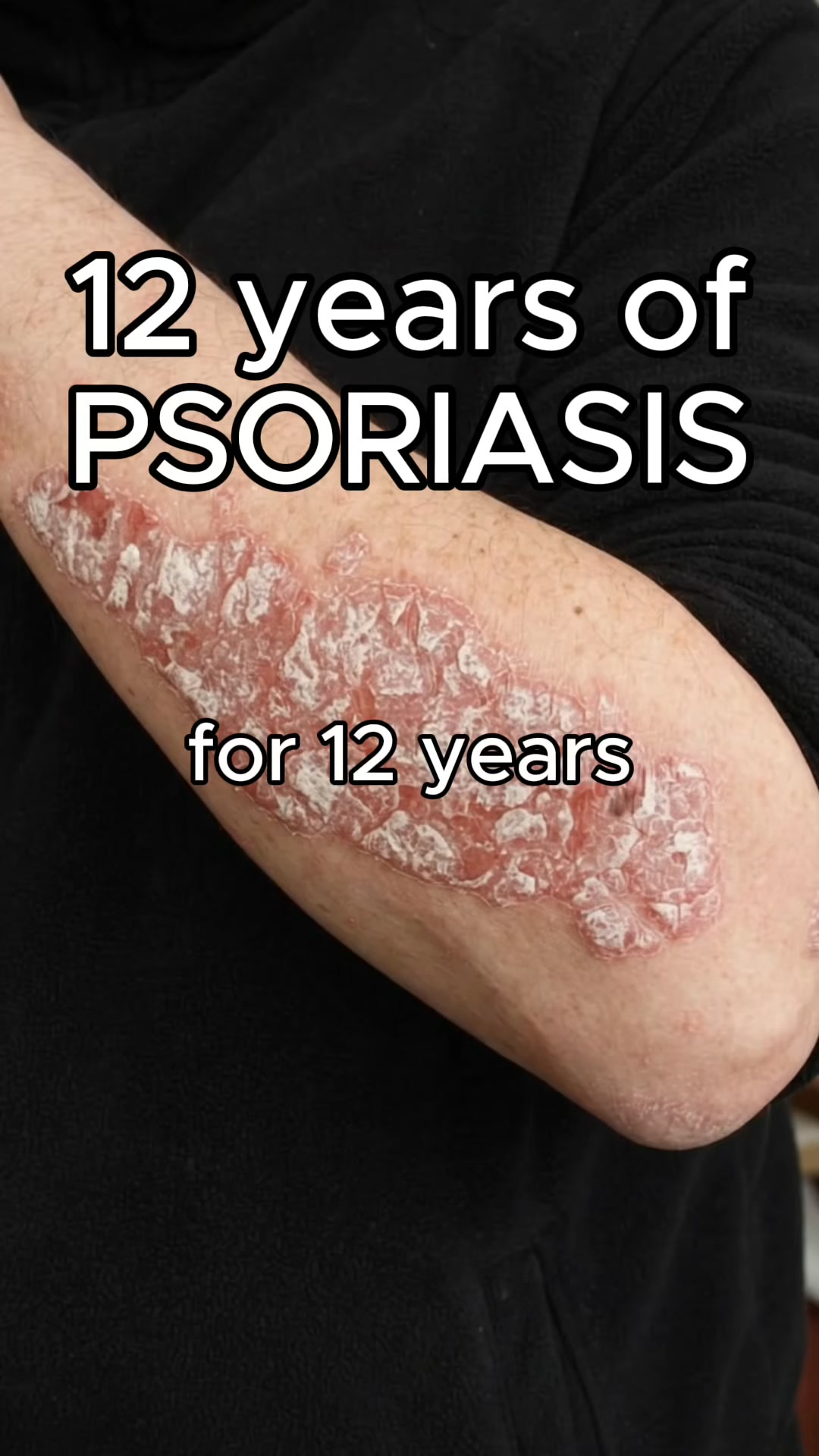 Psoriasis-Prone Skin, Meet Methylene Blue.