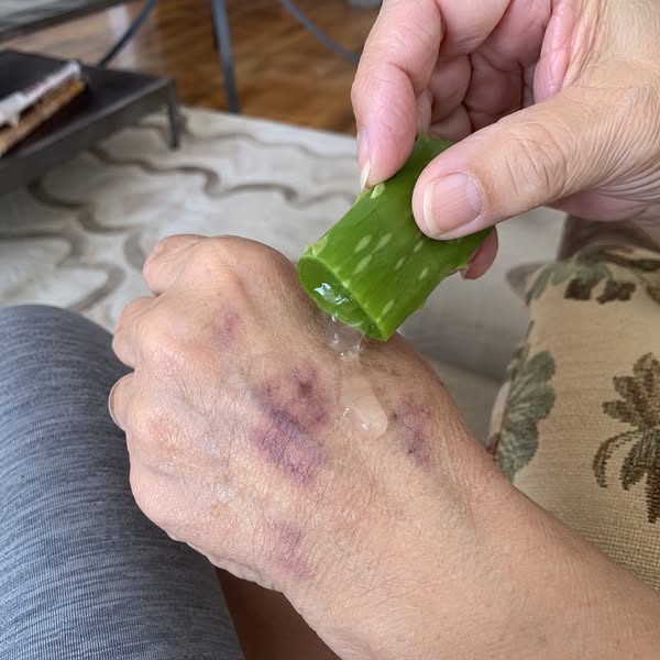 Read this if you wake up to bruises you cannot explain