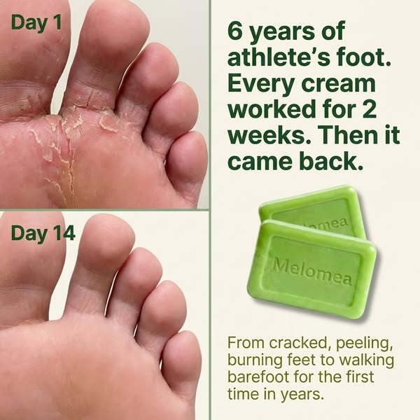 Say Goodbye to Fungal Rashes. For Good.