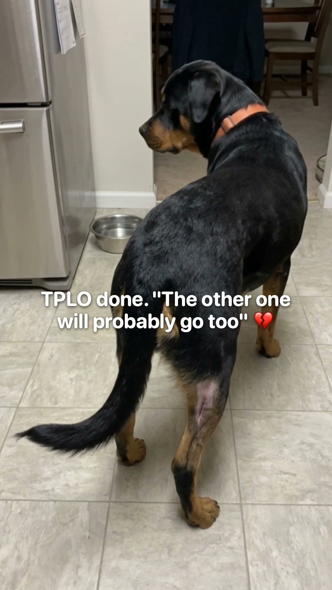 One Op. Both Knees.