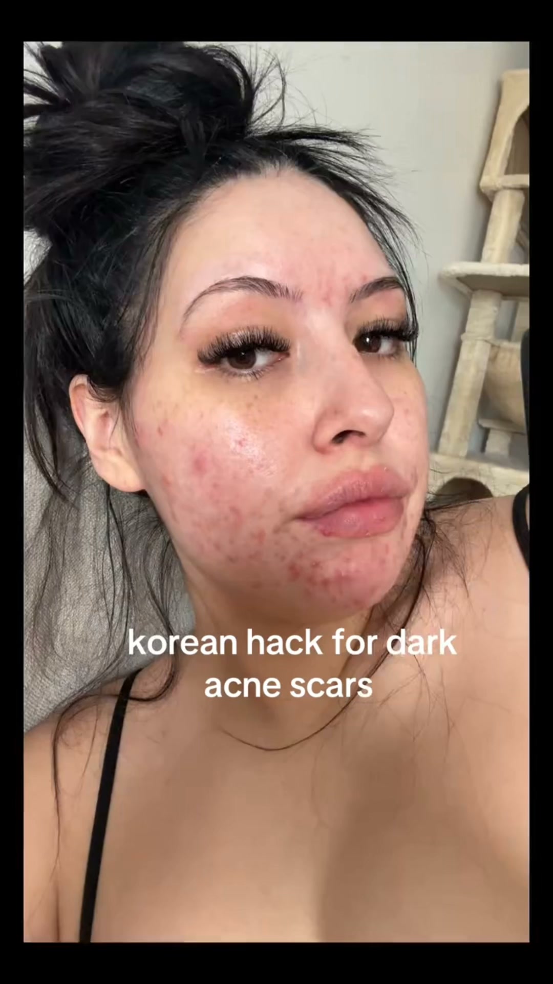 The Korean Answer To Acne’s Aftermath