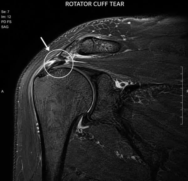 Shoulder still hurts after physio? Here's what you're missing.