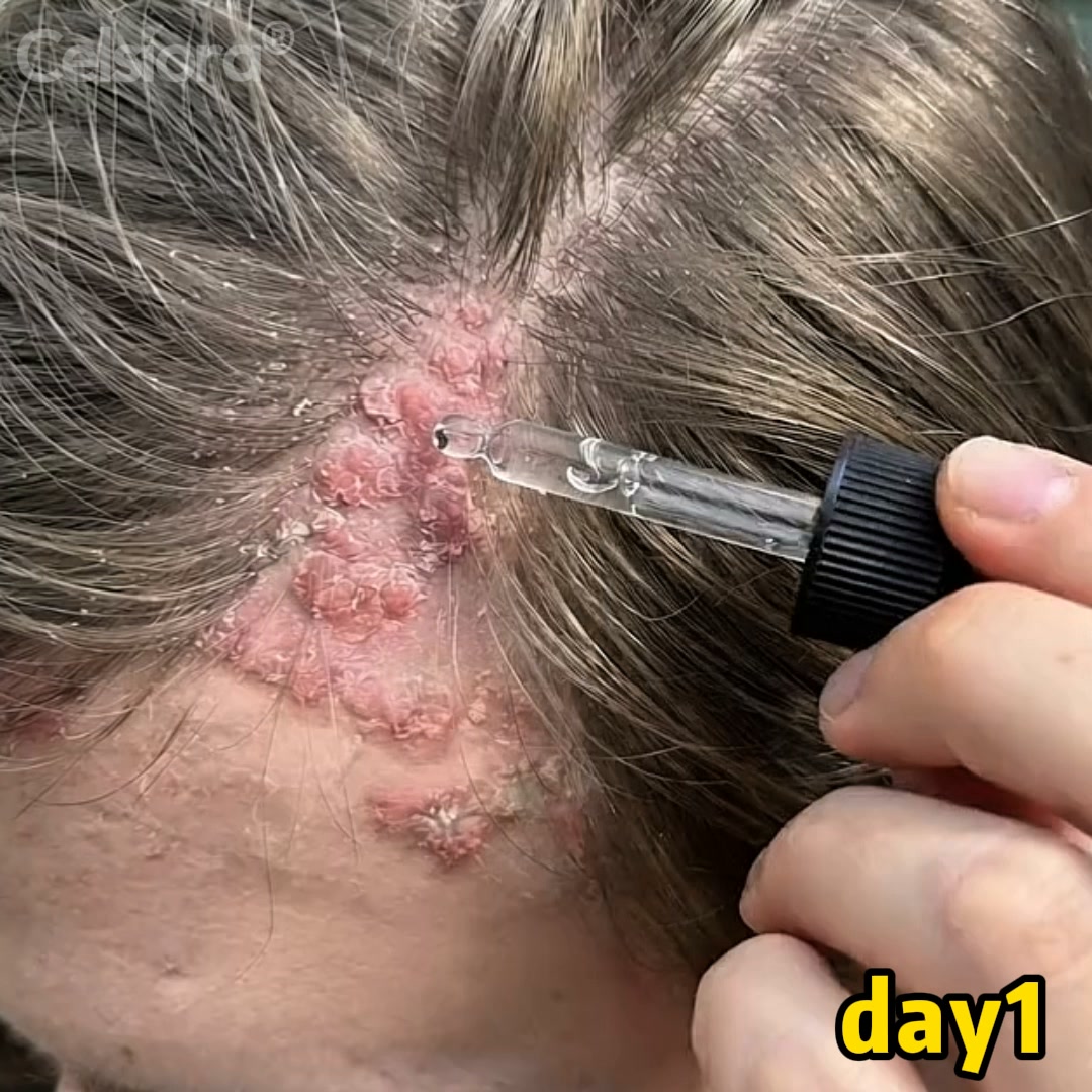 Finally Calm Seborrhoeic Dermatitis Naturally – 50% OFF Today