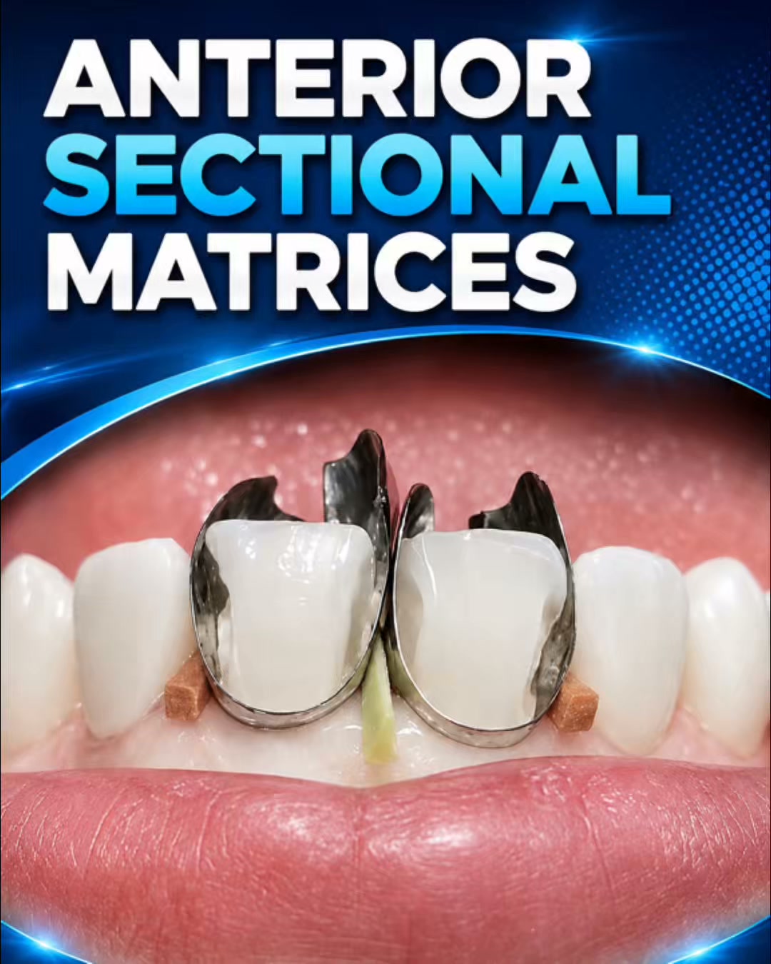 Anterior Sectional Matrices —Natural Contours. Less Finishing Time.