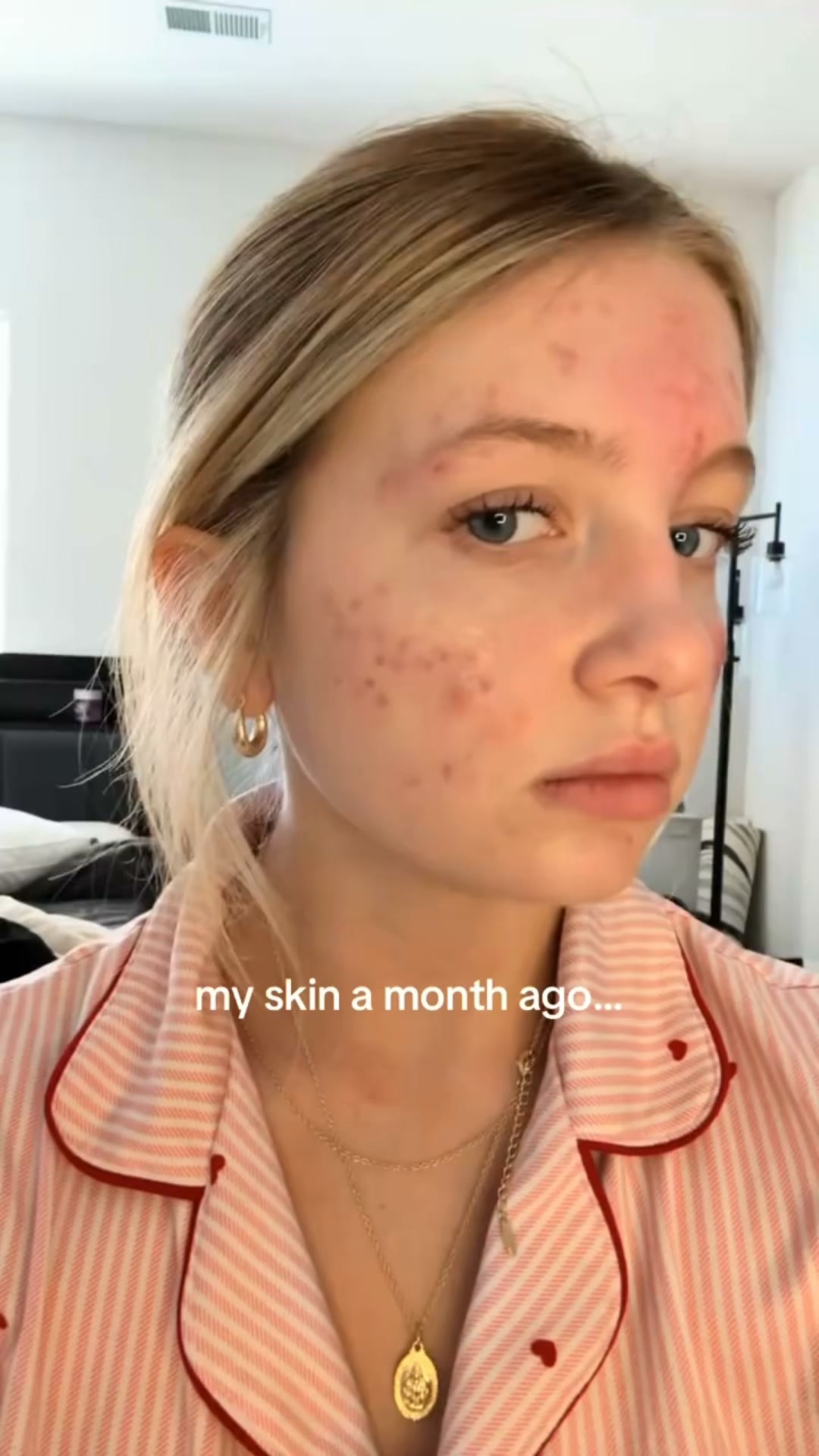 The Korean Answer To Acne’s Aftermath