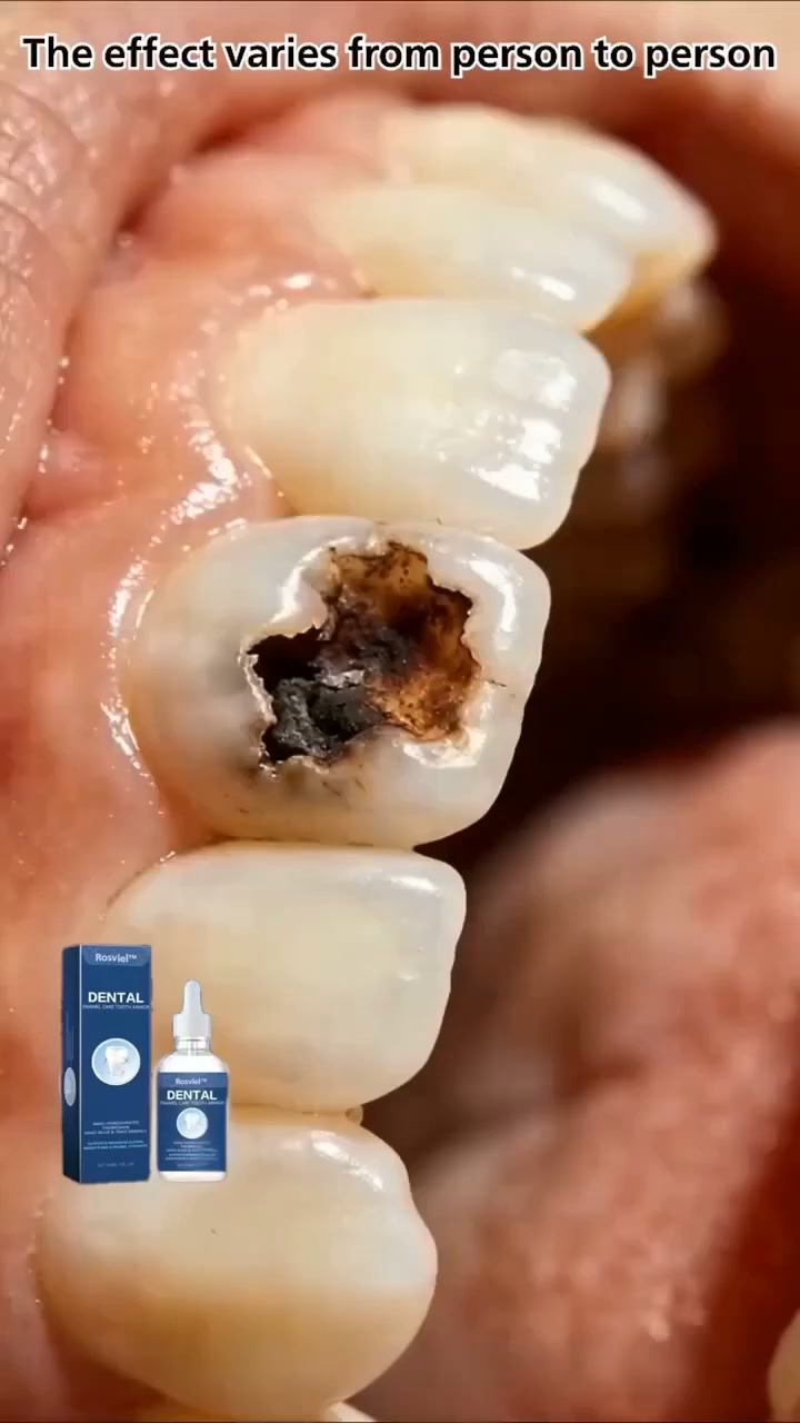Rosviel™ Advanced Enamel Repair & Whitening Kit (Includes Free LED Mirror)