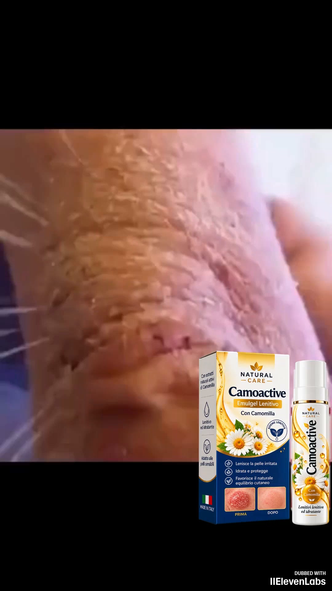 Ho speso €1.800 in 4 anni per la psoriasi. Poi ho trovato qualcosa che costa €49.