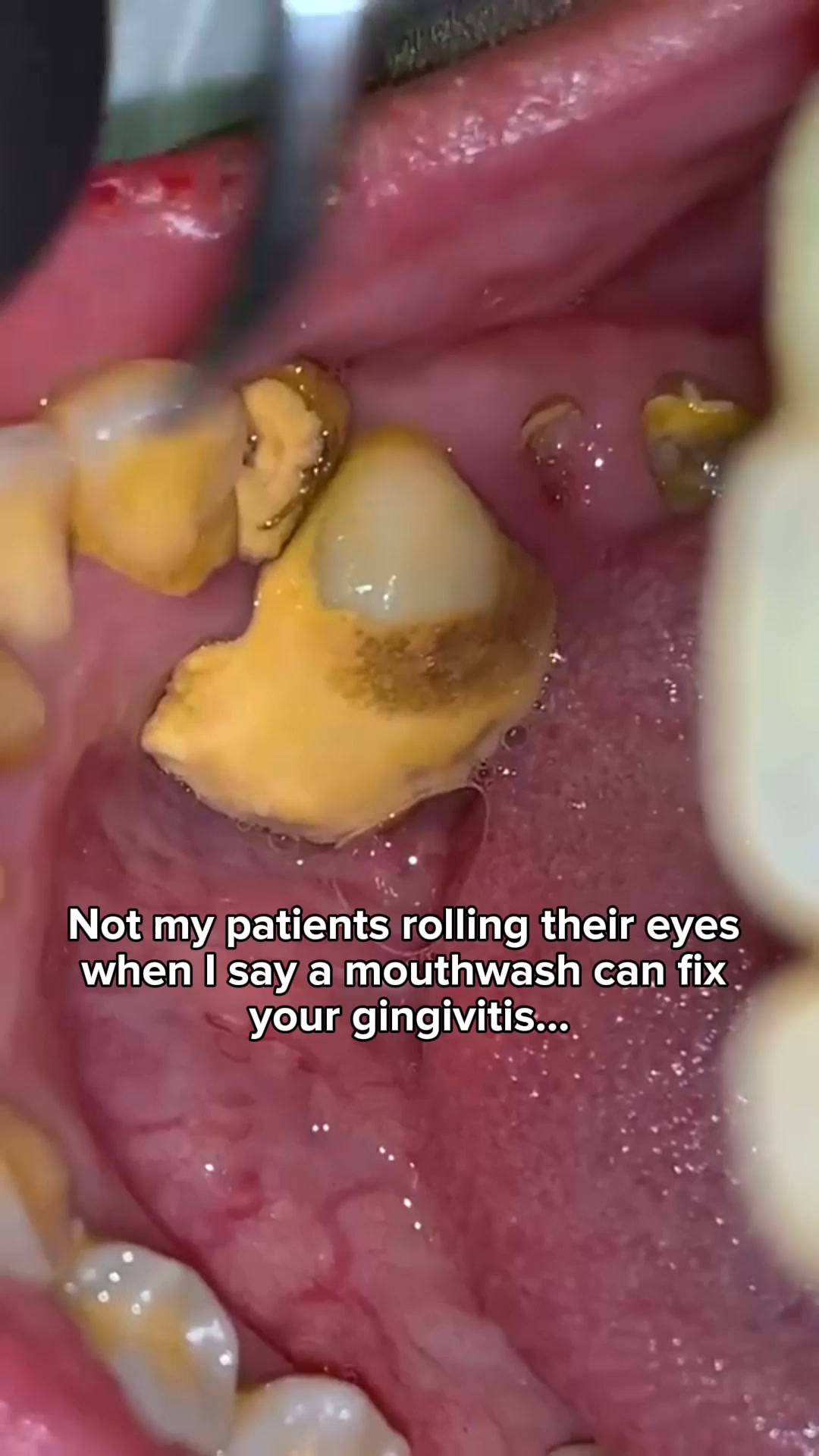Dentist Developed - Fight Gingivitis at Your Gum Line