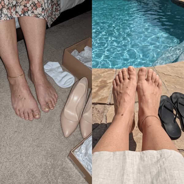 Why Nothing Works For Toenail Fungus