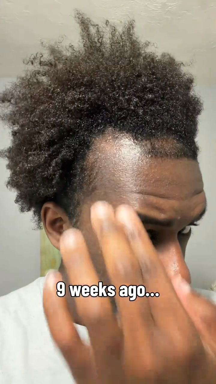 Hair thinning at the crown or temples?