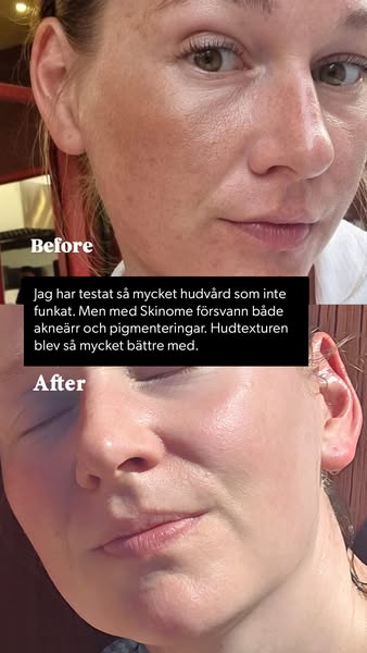 Testat allt? Upptäck Skinome Azeretinal