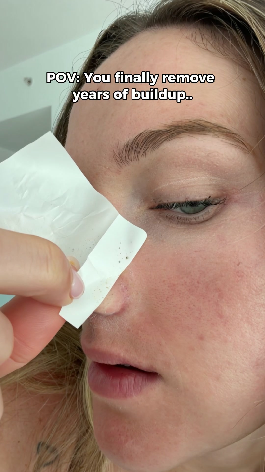 Eliminate Blackheads - Fast