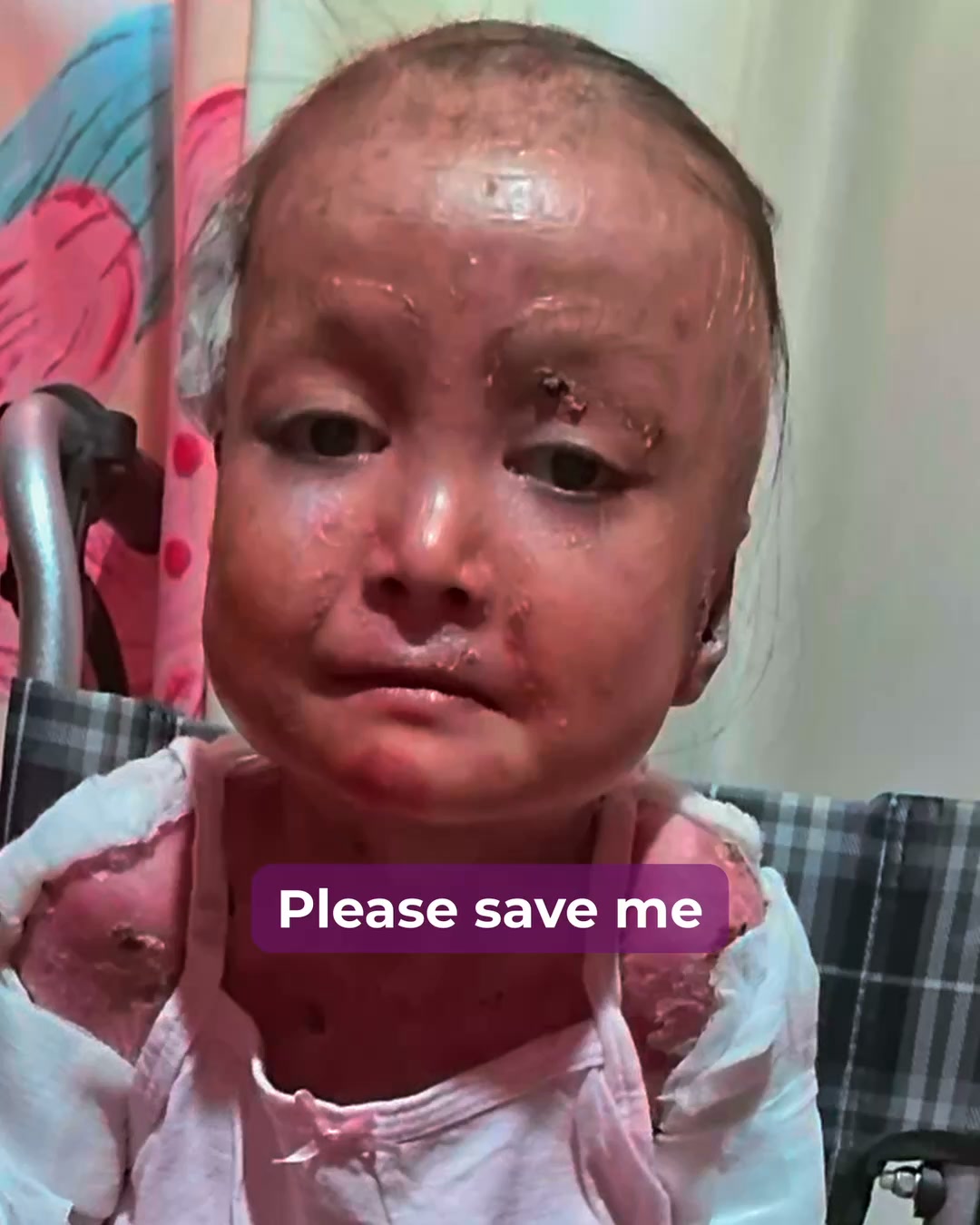 Shamila’s Skin Is Falling Off. Help Her.