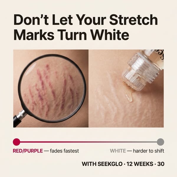 Stretch Marks? Try This At Home