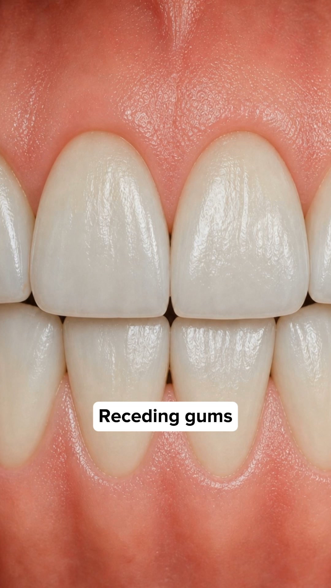 My Gums Kept Pulling Back
