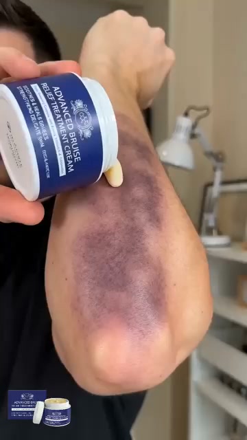The Truth About "Miracle" Bruise Creams