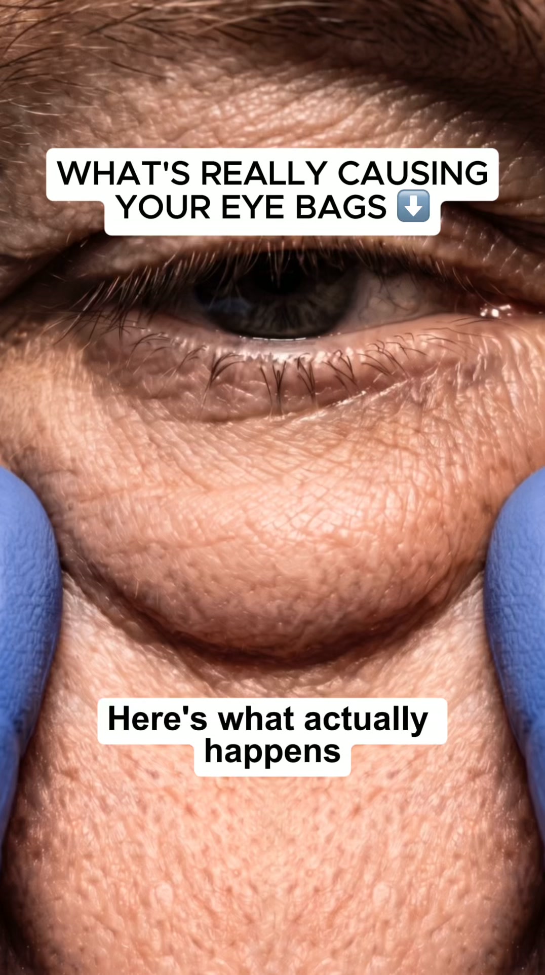 Bye bye eye bags